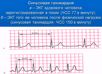 Синусовая такхикардия, ЭКГ