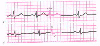 ЭКГ при экстрасистолии из АВ - соединения