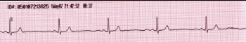 Синусовая брадикардия на ЭКГ, снятой со скоростью 25 мм/сек