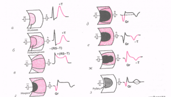 Динамика изменений ЭКГ в острой, подострой и руб­цовой стадиях инфаркта миокарда. а - е - острая стадия; ж - подострая стадия; з - рубцовая стадия