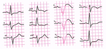 ЭКГ при переднеперегородочном и верхушечном ин­фаркте миокарда
