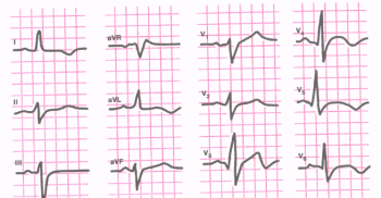 ЭКГ при заднедиафрагмальном (нижнем) инфаркте миокарда