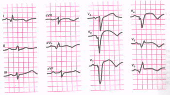 ЭКГ при инфаркте миокарда задней стенки левого желудочка