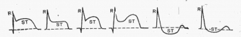 ЭКГ при остром коронарном синдроме. Варианты смещения сегмента ST при повреждении