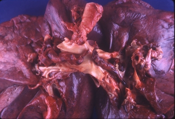 Тромб в лёгочной артерии (ТЭЛА)