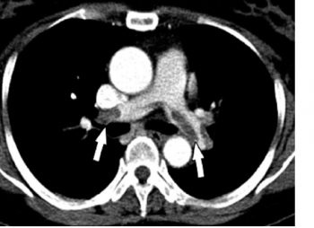 КТ-картина тромбоэмболии главных лёгочных артерий при КТ-ангиографии