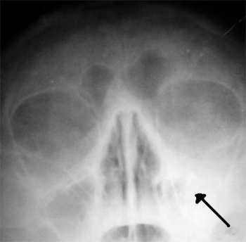 Рентгеновский снимок пазух больного гайморитом (стрелкой обозначено затемнение в области верхнечелюстной пазухи, указывающее на присутствие в ней жидкости)