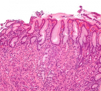 Микрофотография слизистой оболочки желудка больного хеликобактерным гастритом