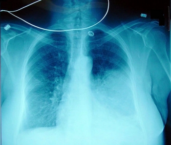 Рентгенография при пневмонии