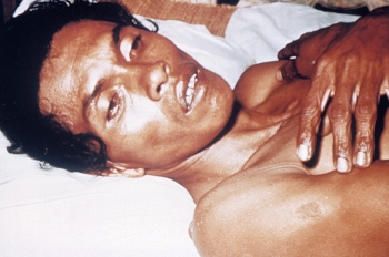 Человек с тяжелой формой обезвоживания из-за холеры. Обратите внимание на запавшие глаза и снижение тургора кожи