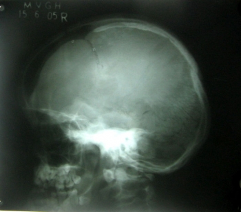 Перелом черепа