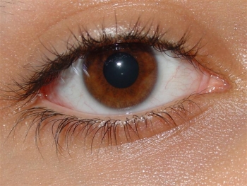 Статус локалис при химическом ожоге глаз