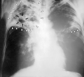 Рентгенограмма органов грудной клетки больного туберкулёзом легких с распадом